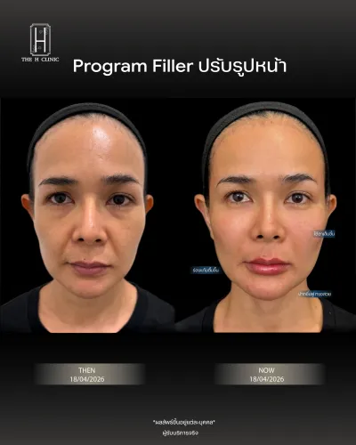 Filler ปรับรูปหน้า