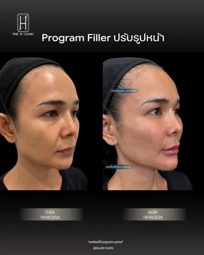 Filler ปรับรูปหน้า