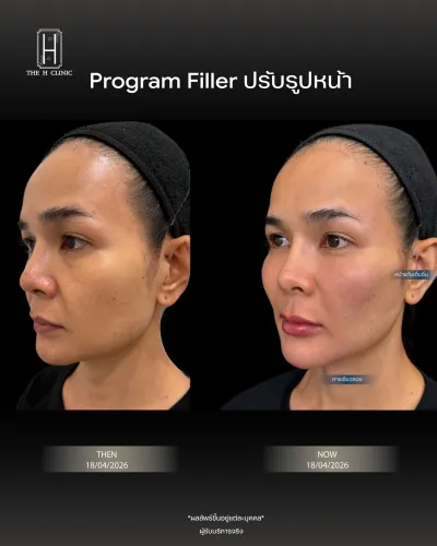 Filler ปรับรูปหน้า